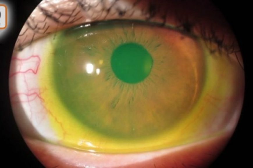 視事關心：乾眼症女性長者多　視光師處理方法